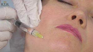 Восстановление волос с помощью полинуклеотидов Plinest