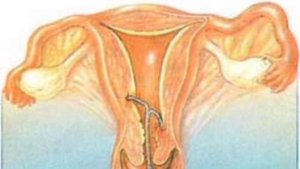 СПИРАЛ УСТИДАН ХОМИЛАДОР БЎЛИШ