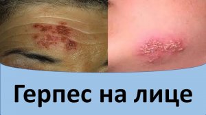 Герпес на лице.