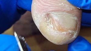 Nails that are too thick are uncomfortable for the patient【Xue Yidao Pedicure】