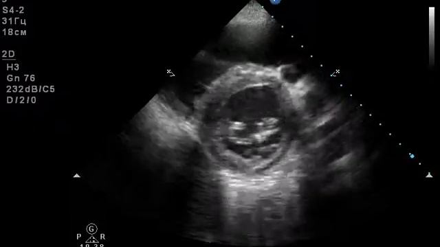 образование левого желудочка(вероятно миксома)5 смотреть онлайн