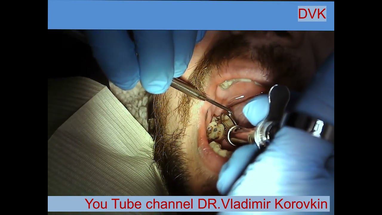 Infiltration anesthesia for treatment 47 tooth.#localanaesthesia #nerveblock