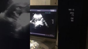 Третий скрининг)