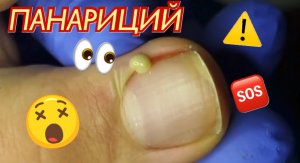 Панариций ?????