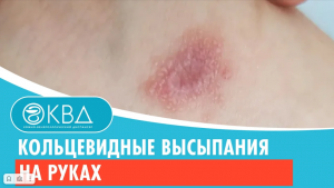? Кольцевидные высыпания на руках. Клинический случай №357
