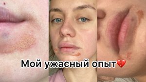 УВЕЛИЧЕНИЕ ГУБ. МОЙ УЖАСНЫЙ ОПЫТ. ВСЯ ПРАВДА.