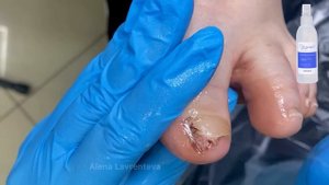 Бытовая травма / Травма ногтя / ушибла ноготь на ноге / сорвала ноготь на ноге