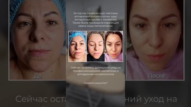 До и после курса косметологических процедур #косметология #лифтинг #допосле #уходзалицом смотреть онлайн