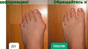 Магнитная Вальгусная Шина Magnetfix Отзывы