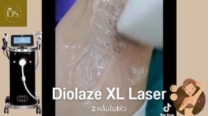 มากำจัดขนด้วยเลเซอร์2พลัง (DIOLAZE XL LASER (2คลื่นใน1หัว)