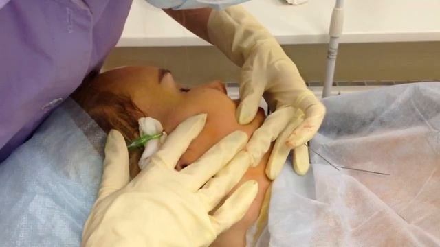 Постановка лифтинговых нитей ArtLift в IMEXPERT (INMEDEX). Врач-косметолог Смирнова Надежда Ивановн смотреть онлайн