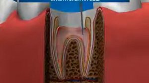 Штифт пломба