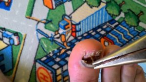 Удаление ногтя плоскогубцами