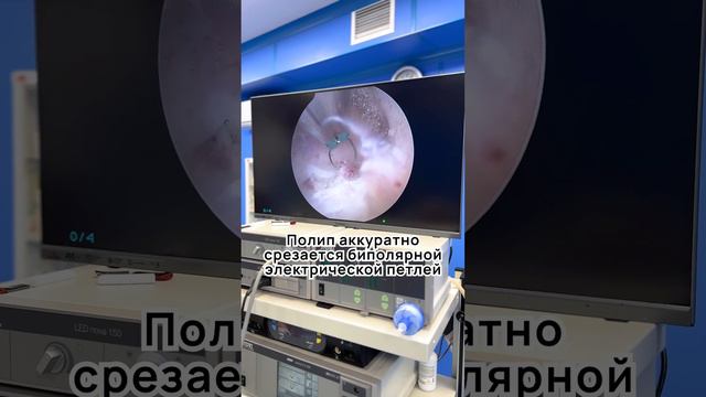 Гистерорезектоскопия. Удаление полипа в матке
