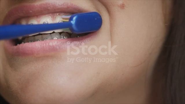 ПРАВДА про БРЕКЕТЫ, которую ВАМ НЕ РАССКАЖЕТ ВРАЧ - МОЙ ОПЫТ смотреть онлайн