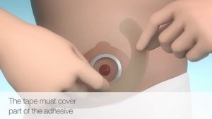 Эластичная пластина полукольцо Brava, арт 120700, Coloplast