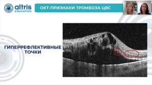 Нарушения кровообращения в системе центральной вены сетчатки: особенности визуализации на ОКТ