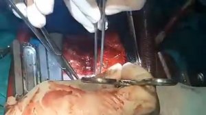 Тромбэктомия из левого желудочка сердца