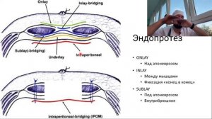 Современные виды герниопластики. TAPP/TEP. Сетчатый эндопротез. Сетка