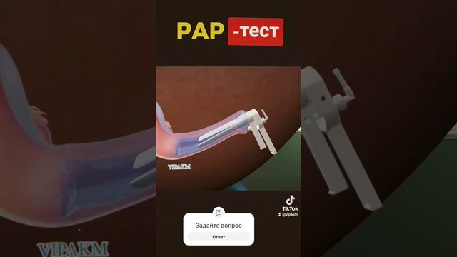 Пап тест:простой способ проверить здоровье шейки матки рак шейки матки #гинекология #онкология #рак