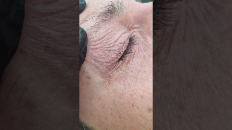 заметили что поменялось? #shortsvideo #shortvideo #папилломы #тренд #top #new #newvideo #dermatology