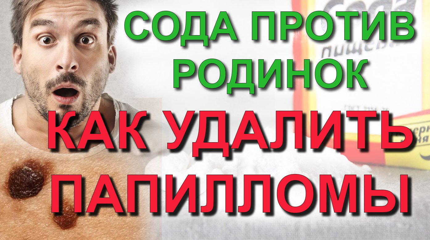 ✅ СОДА против Родинок и Папиллом: Личный опыт удаления растущих и затвердевших Родинок и Папиллом