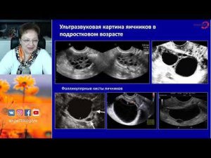 Экспертология | Функциональные кисты яичников Пустотина О.А.