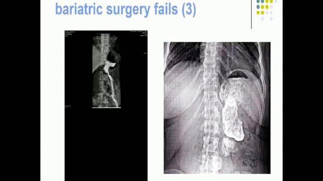 Жером Даржент "Бариатрическая эндоскопия – возможности применения при повторных вмешательствах" смотреть онлайн