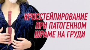 ✅ КРОССТЕЙПИРОВАНИЕ ПАТОГЕННОГО ШРАМА НА ГРУДНОЙ КЛЕТКЕ | Валентин Гайт | Учебный центр BBALANCE