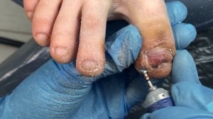 Ушиб пальца ноги / Отбила ноготь об диван