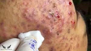 Blackhead Whitehead Removal - Cystic Acne Treatment - Elderly Pimple Popping - Facial Acne Spa |#08
