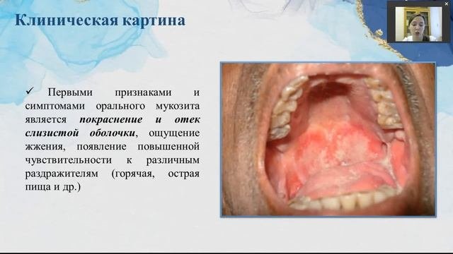 Оральный мукозит