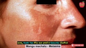 How to Remove DARK SPOTS, BLACK SPOTS | Mangu Machalu | Dr Manthena Satyanarayana Raju Videos