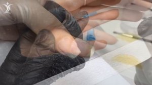 Псевдомония на ногтях (зеленая плесень). Пример обработки