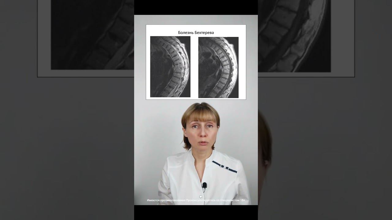 Болезнь Бехтерева Доктор Лисенкова #shorts