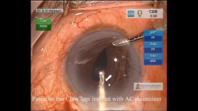 Posterior Iris Claw Lens Implant with AC Maintainer смотреть онлайн