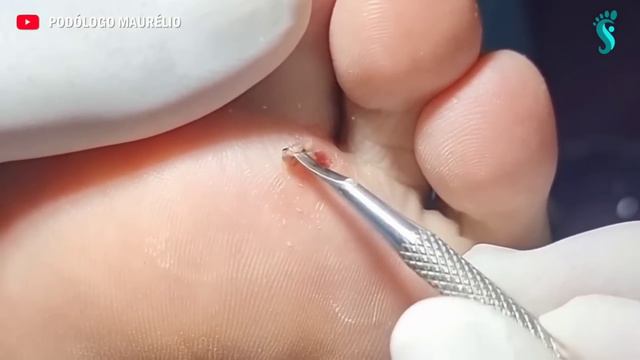 VÍDEOS PARA RELAXAR TÓPICO (3) #podologomaurelio #ingrowntoenail #nails #like #podologia смотреть онлайн