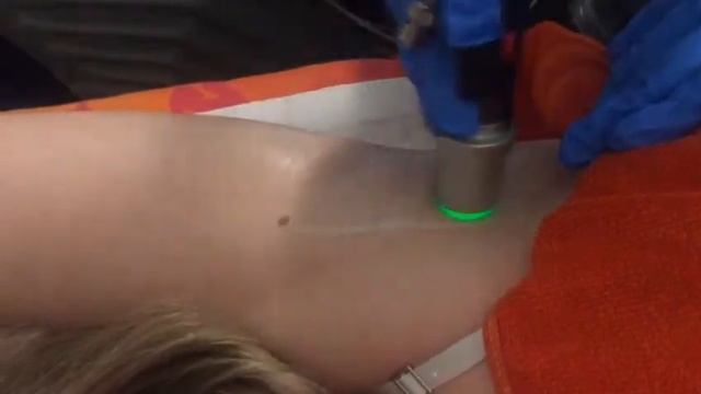 Painless Laser Hair Removal of Arm Pit using the Motus AY Laser at Reading Cosmetic Laser. смотреть онлайн
