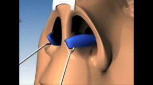 Закрытая ринопластика, доступ с высвобождением хрящей кончика. Др. Акопов