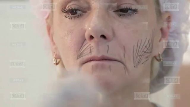 Контур губ. Сепарирование канюлей кисета верхней губы. Носогубная складка