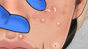 [ASMR] 잘익은 여드름,블랙헤드 한번에 짜기 / Acne, Big Blackhead Removal Animation