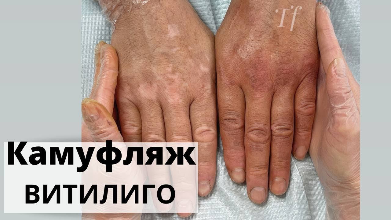 КОРРЕКЦИЯ камуфляжа витилиго. Камуфляж витилиго на руках. Результат камуфляжа витилиго ДО / ПОСЛЕ.