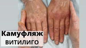 КОРРЕКЦИЯ камуфляжа витилиго. Камуфляж витилиго на руках. Результат камуфляжа витилиго ДО / ПОСЛЕ.