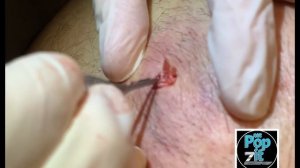 Large inflamed cyst. I+D medical procedure. Large cyst pop. Cyst hits the floor. Juicy pocket.