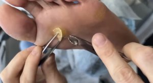 Стержневой мозоль