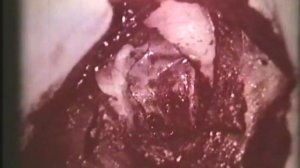 Травмы свода черепа. Первичная хирургическая обработка © Cranial vault traumas. Surgical treatment