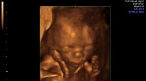 Плод 14 недель 2  дня.