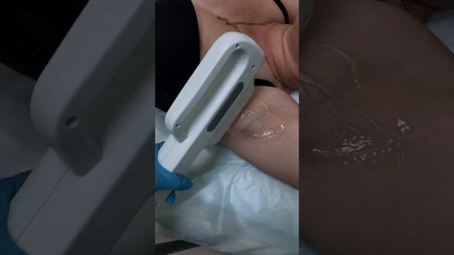 Элос эпиляция подмышек смотреть онлайн