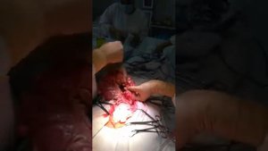 Операция Гартмана