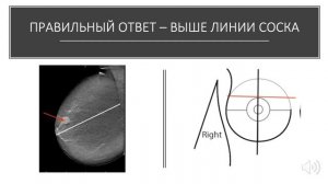 ЛЕКЦИЯ 4. Корреляция данных ультразвукового и  маммографического исследований.